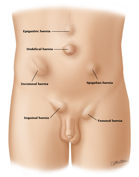 Hernia umbilical o hernia en el ombligo: causas, síntomas y